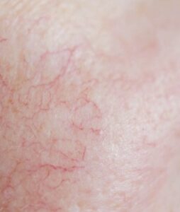 DiapulseX Cryo Kauneushoitola Beautyzone Kuopio. Laajentuneiden pintaverisuonien poisto.